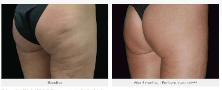 Gallery Cellulite and Body Tightening cellulite