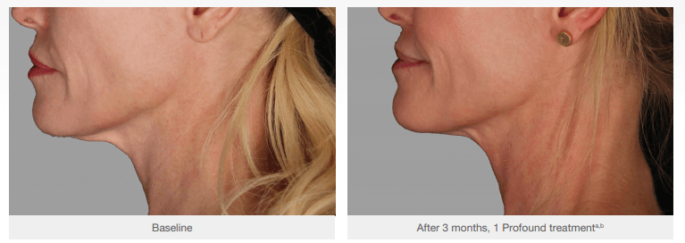 Gallery Face and Neck Tightening beforeafterneck