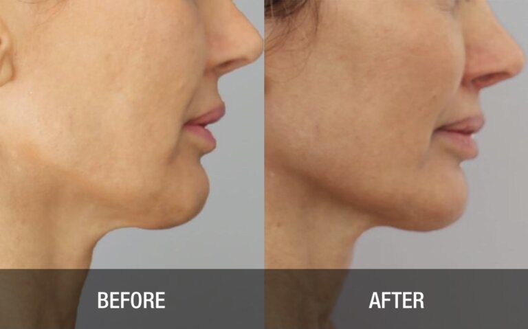 Gallery Face and Neck Tightening chin