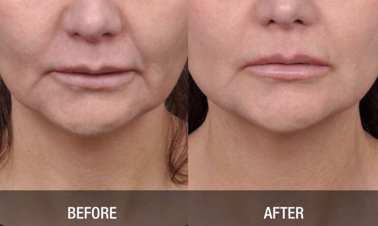 Gallery Face and Neck Tightening lowerface