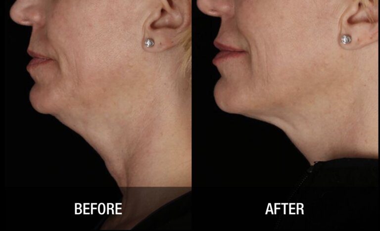 Gallery Face and Neck Tightening neck