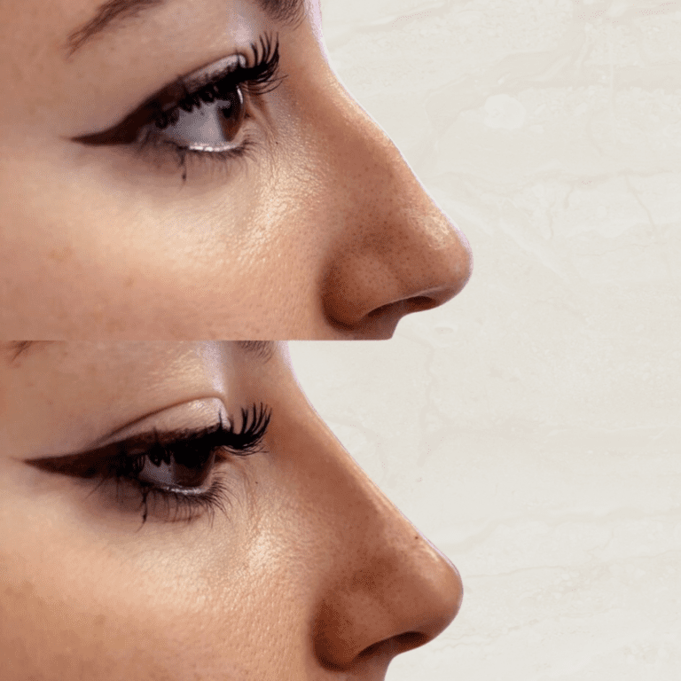 Gallery Non Surgical Nose Job 1 1 png 1