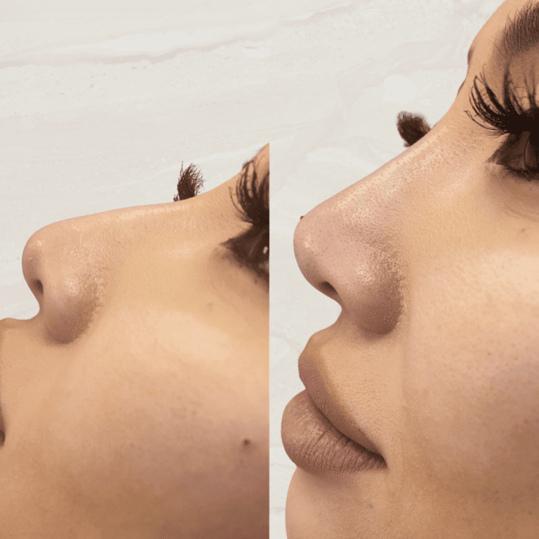 Gallery Non Surgical Nose Job 1 1 png 10
