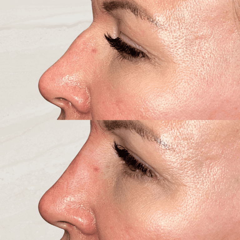 Gallery Non Surgical Nose Job 1 1 png 11