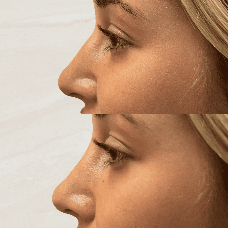 Gallery Non Surgical Nose Job 1 1 png 12