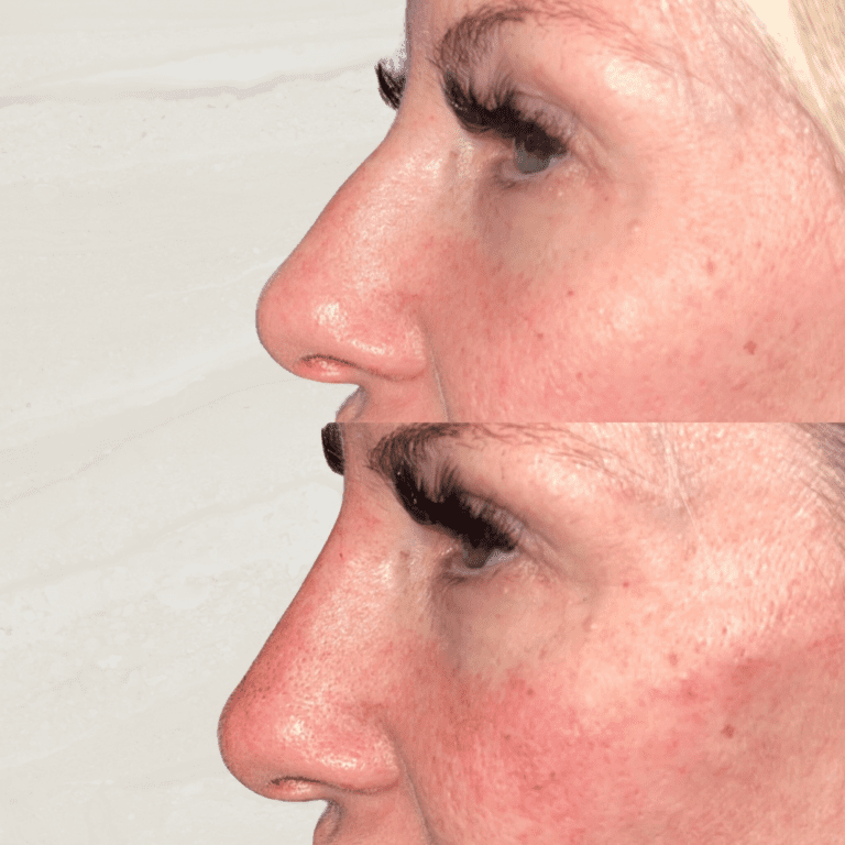 Gallery Non Surgical Nose Job 1 1 png 13