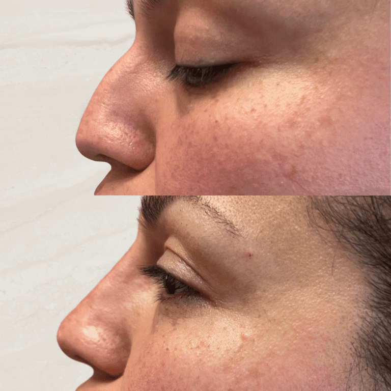 Gallery Non Surgical Nose Job 1 1 png 2