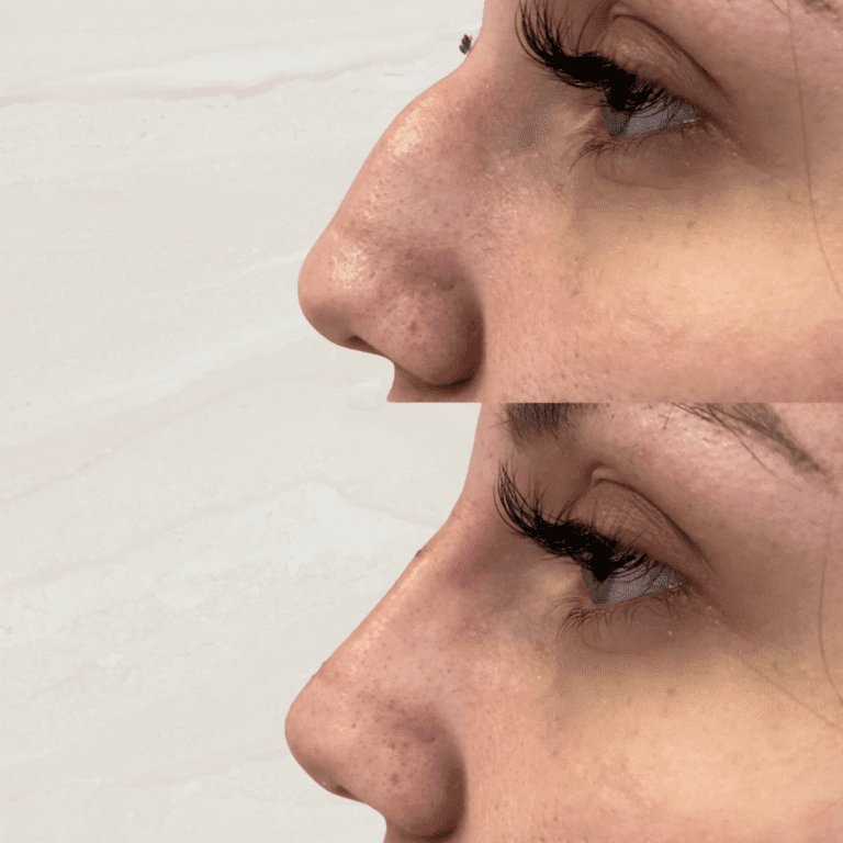 Gallery Non Surgical Nose Job 1 1 png 5