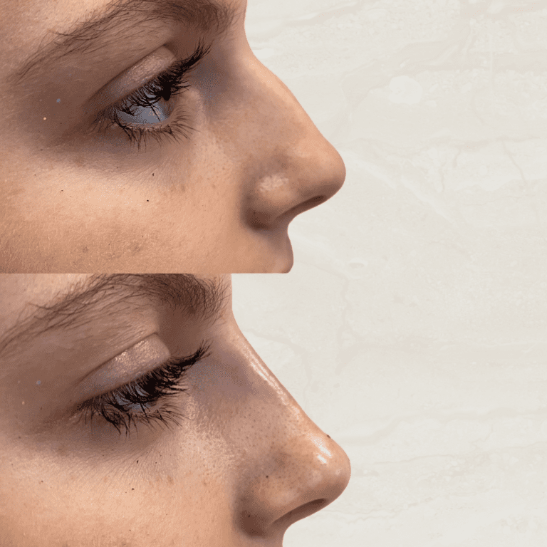 Gallery Non Surgical Nose Job 1 1 png 6