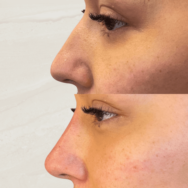 Gallery Non Surgical Nose Job 1 1 png 7