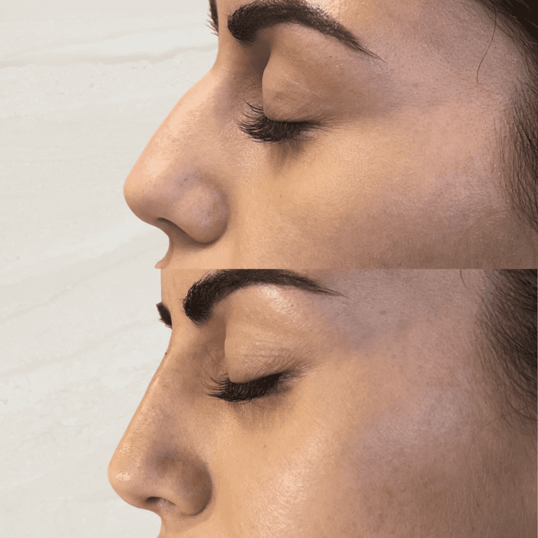 Gallery Non Surgical Nose Job 1 1 png