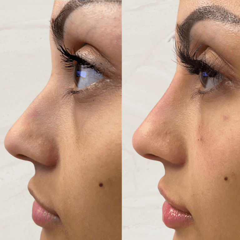 Gallery Non Surgical Nose Job 1 1 png 8